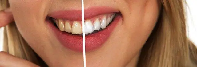 Before and After Results of Teeth Whitening