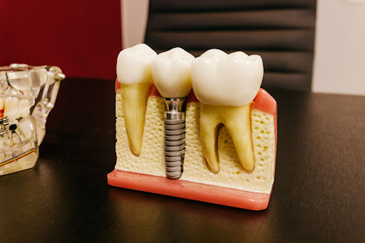 Closeup Of Dental Implant Model
