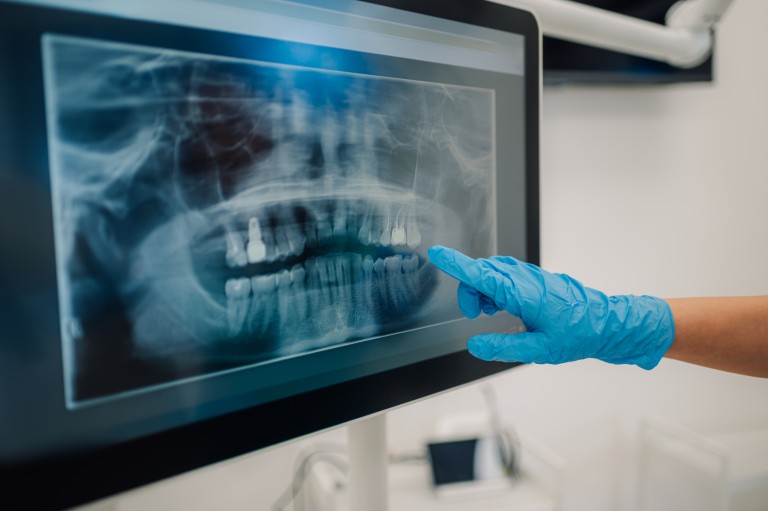 Oral HPV and Oral Cancer