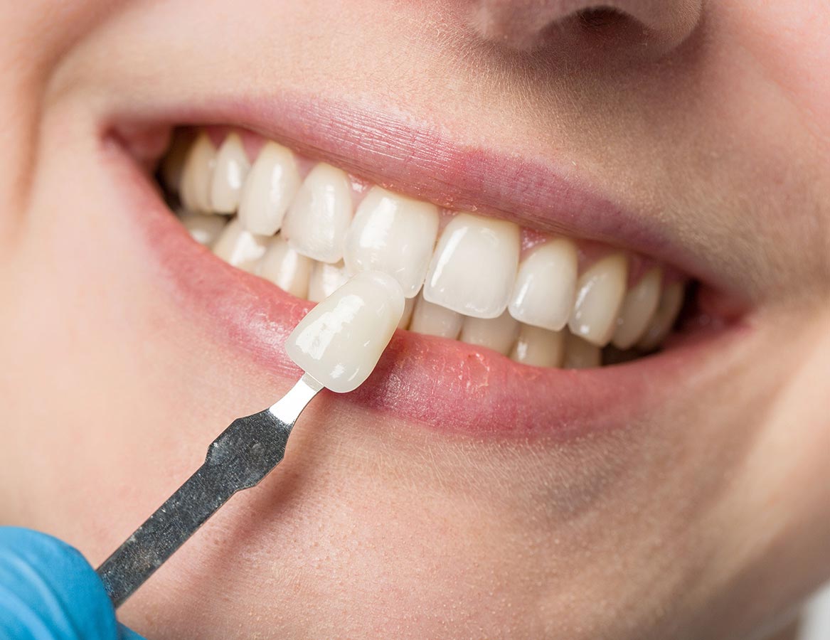 Porcelain Veneers in Farmington Hills, MI