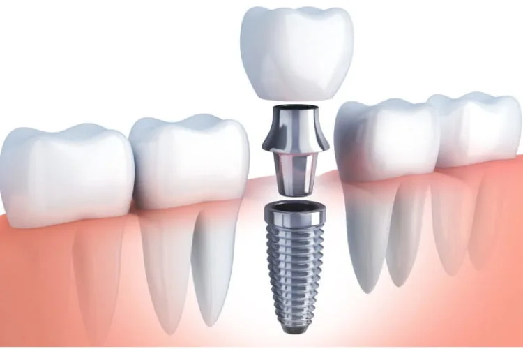 Dental Arts Dental Implants